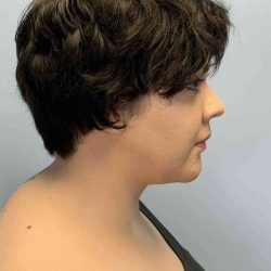 Neck Lift Before & After Patient #11120