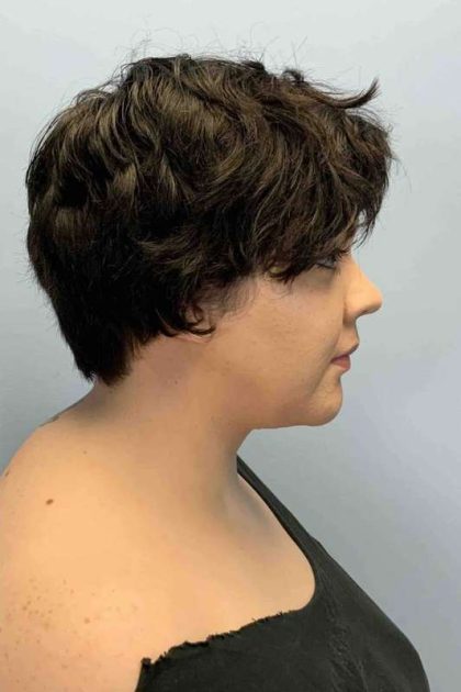 Neck Lift Before & After Patient #11120