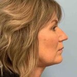 Neck Lift Before & After Patient #11145