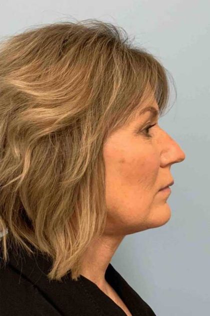 Neck Lift Before & After Patient #11145