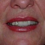 Lip Augmentation Before & After Patient #11160