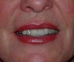 Lip Augmentation Before & After Patient #11160