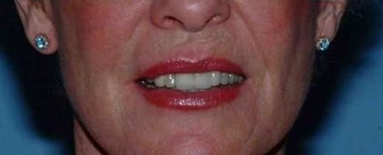 Lip Augmentation Before & After Patient #11160