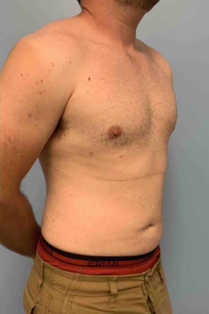 Gynecomastia Before & After Patient #11237