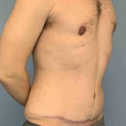 Gynecomastia Before & After Patient #11246