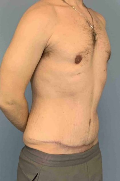 Gynecomastia Before & After Patient #11246