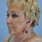 Facelift Before & After Patient #11380