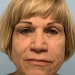 Facelift Before & After Patient #11389