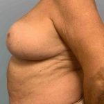 Breast Reduction Before & After Patient #11838