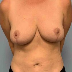 Breast Reduction Before & After Patient #11847