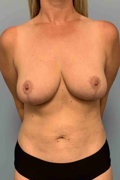Breast Reduction Before & After Patient #11847