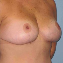 Breast Lift Before & After Patient #12010
