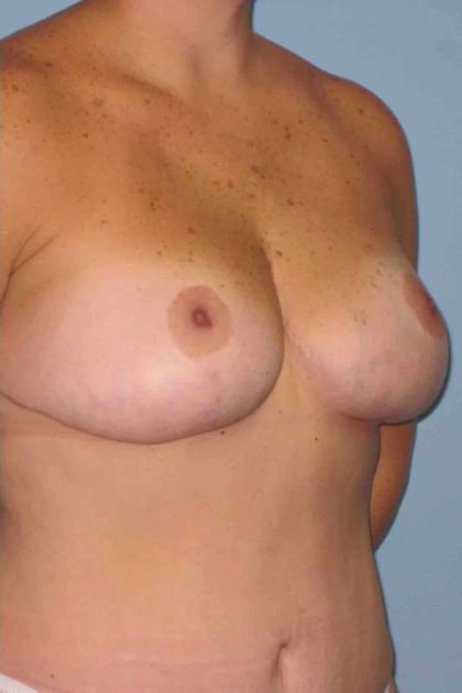 Breast Lift Before & After Patient #12010