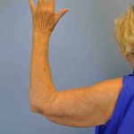 Brachioplasty Before & After Patient #12348