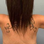 Brachioplasty Before & After Patient #12362
