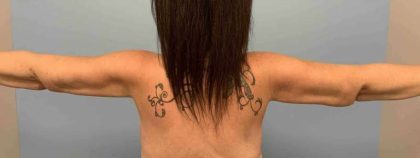 Brachioplasty Before & After Patient #12362