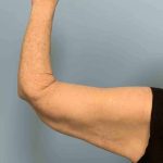 Brachioplasty Before & After Patient #12371
