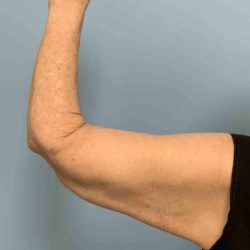 Brachioplasty Before & After Patient #12371