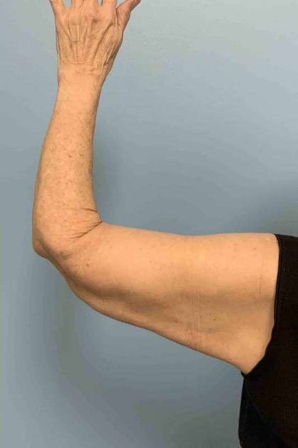 Brachioplasty Before & After Patient #12371