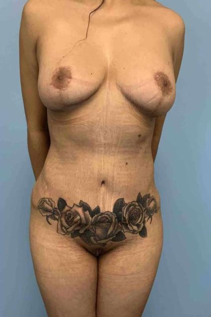 VASER Liposelection Before & After Patient #10416