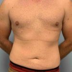 VASER Liposelection Before & After Patient #10434