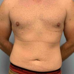VASER Liposelection Before & After Patient #10434
