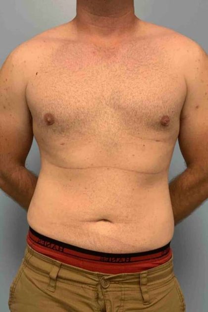 VASER Liposelection Before & After Patient #10434