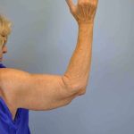 Brachioplasty Before & After Patient #12348