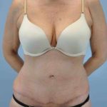 VASER Liposelection Before & After Patient #10511