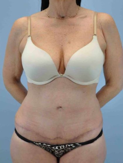 VASER Liposelection Before & After Patient #10511