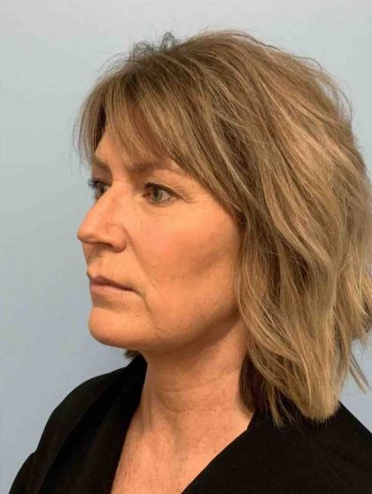 Renuvion Before & After Patient #10971