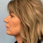 Neck Lift Before & After Patient #11145
