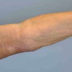 VASER Liposelection Before & After Patient #10615