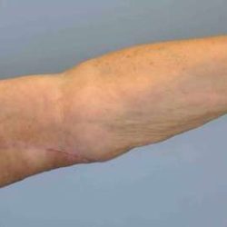 VASER Liposelection Before & After Patient #10615