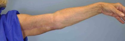 VASER Liposelection Before & After Patient #10615