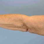 Brachioplasty Before & After Patient #12348