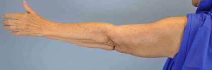 Brachioplasty Before & After Patient #12348