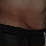 Tummy Tuck Before & After Patient #10689
