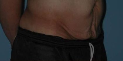 Tummy Tuck Before & After Patient #10689