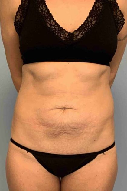 Tummy Tuck Before & After Patient #10721