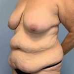 VASER Liposelection Before & After Patient #10391