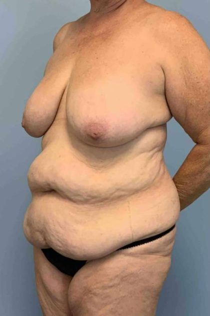 VASER Liposelection Before & After Patient #10391