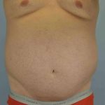 Tummy Tuck Before & After Patient #10749