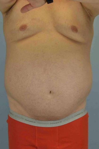 Tummy Tuck Before & After Patient #10749