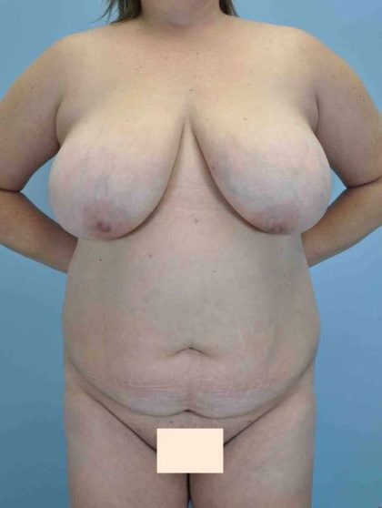 Tummy Tuck Before & After Patient #10765