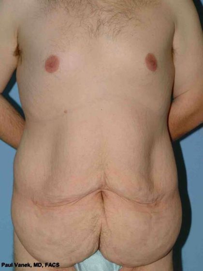 Tummy Tuck Before & After Patient #10774
