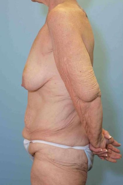 Tummy Tuck Before & After Patient #10793
