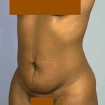 Tummy Tuck Before & After Patient #10839