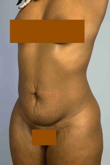 Tummy Tuck Before & After Patient #10839