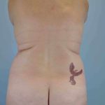 VASER Liposelection Before & After Patient #10384